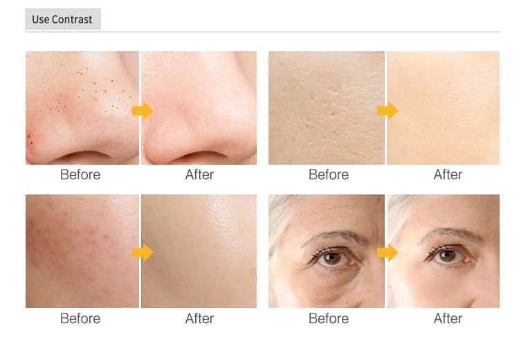 PEELING FACIAL ULTRASÓNICO